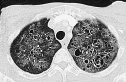 Cystic Fibrosis - CTisus CT Scan