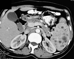 Klippel-Trenaunay-Weber (KTW) Syndrome With Lung Cysts and Splenic Hemangiomas - CTisus CT Scan