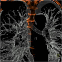 Collapsed Left Lower Lobe - CTisus CT Scan