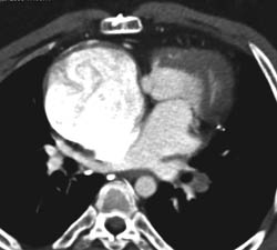 Pulmonary Embolism (PE) With Large Right Atrium - CTisus CT Scan