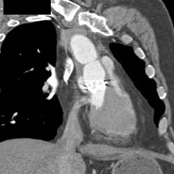 Pe - CTisus CT Scan