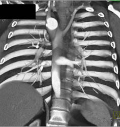 Pe - CTisus CT Scan