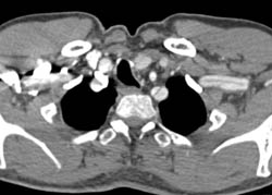 Aberrant Left Subclavian Artery With Dissection - CTisus CT Scan