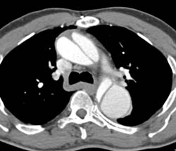 Arch Dissection - CTisus CT Scan