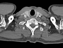 Dissection Extends Into Left Subclavian Artery - CTisus CT Scan