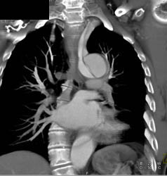 Dissection Extends Into Arch Vessels - CTisus CT Scan