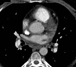 Pe - CTisus CT Scan