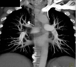 Pe - CTisus CT Scan