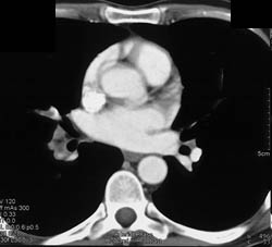 Pe - CTisus CT Scan