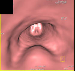 Endoluminal Mass in Left Mainstem Due to Small Cell Lung Cancer - CTisus CT Scan