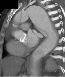 Type A Dissection - CTisus CT Scan