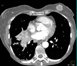 Renal Cell Carcinoma With Lung, Soft Tissue, Liver, and Adrenal Metastases - CTisus CT Scan