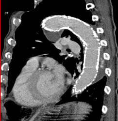 Endovascular Stent - CTisus CT Scan