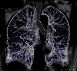 Bronchiectasis - CTisus CT Scan