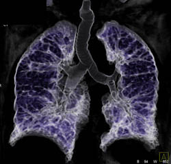 Bronchiectasis - CTisus CT Scan