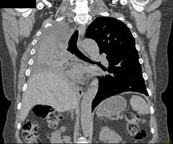 Mucus Plugging With Occluded Right Mainstem Bronchus - CTisus CT Scan