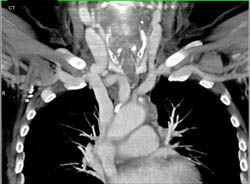 Ectatic Venous Structures - CTisus CT Scan