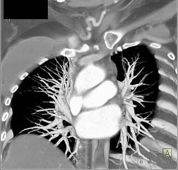 Patent SVC With Pseudothrombus - CTisus CT Scan