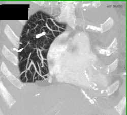 Embolization of Pulmonary Arteriovenous Malformation (PAVM) - CTisus CT Scan