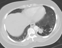 Sequestration Left Lower Lobe With Air Trapping - CTisus CT Scan