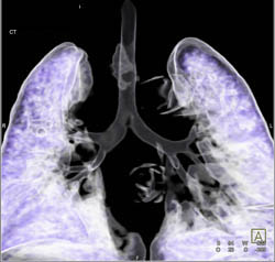 Narrowed Right Lower Bronchus - CTisus CT Scan