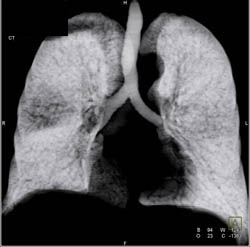 Dilated Bronchial Arteries - CTisus CT Scan