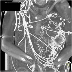 Extensive Abdominal and Chest Wall Collaterals With Catheter in IVC and SVC Occlusion - CTisus CT Scan