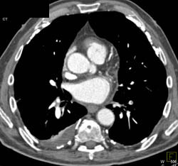 Asbestos Exposure - CTisus CT Scan