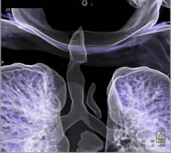 Benign Trachea Mass Compresses the Airway - CTisus CT Scan