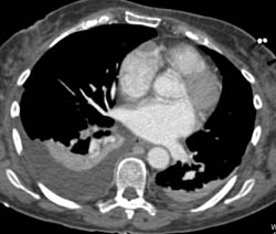 Pulmonary Embolism - CTisus CT Scan