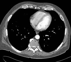 Pulmonary Embolism - CTisus CT Scan