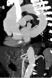 Ulceration in Ascending Aorta - CTisus CT Scan