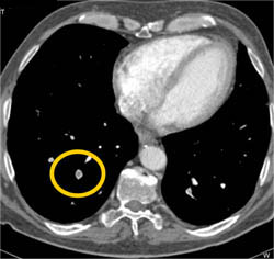 Pulmonary Embolism - CTisus CT Scan