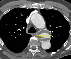 Ductus Aneurysm - CTisus CT Scan