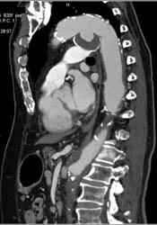 Ductus Aneurysm - CTisus CT Scan