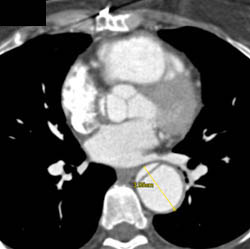 Type A Dissection - CTisus CT Scan