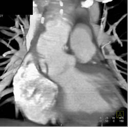 Type A Dissection - CTisus CT Scan