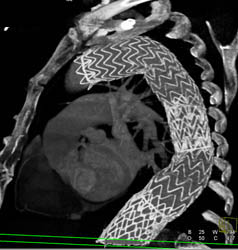 Stent in Descending Aorta and Arch - CTisus CT Scan