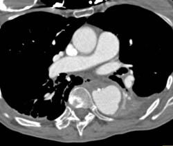 Focal Ulceration in Descending Aorta and Abdominal Aorta- See Sequence of Images - CTisus CT Scan