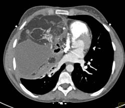 Teratoma in Multiple Visualizations - CTisus CT Scan