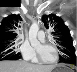 SVC Syndrome With Narrowed SVC Abd Collaterals - CTisus CT Scan