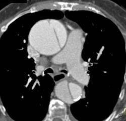 Type A Dissection - CTisus CT Scan