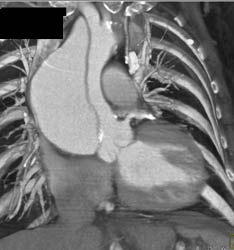 Type A Dissection - CTisus CT Scan