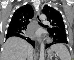 Bronchogenic Cyst - CTisus CT Scan