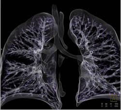 Bronchogenic Cyst - CTisus CT Scan