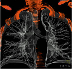 Bronchogenic Cyst - CTisus CT Scan