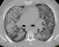 Pulmonary Hemorrhage - CTisus CT Scan