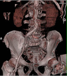 Iliac Artery Occlusion in Patient With Pe - CTisus CT Scan