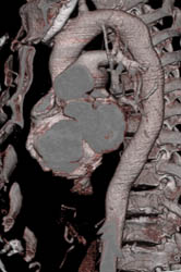 Clot in Ascending Aorta Occluding Superficial Femoral Artery (SFA) and Pulmonary Emboli (PEs) - CTisus CT Scan