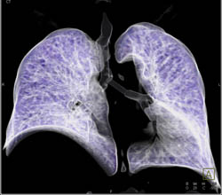 Stent in Airway S/P Lung Transplants - CTisus CT Scan